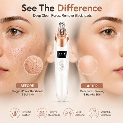 Blackhead Remover Vacuum – Rechargeable Pore Cleaner with Suction Control